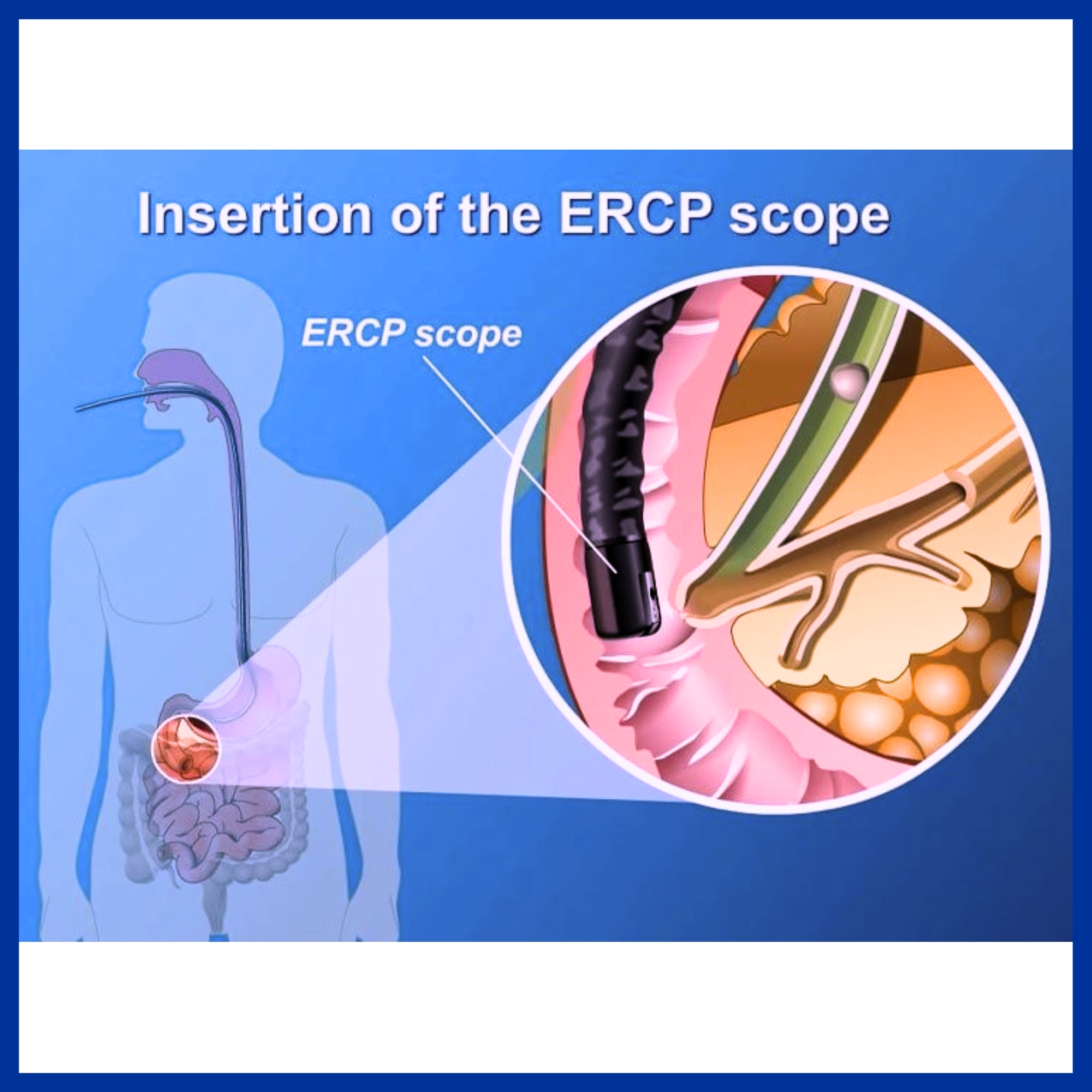 ERCP