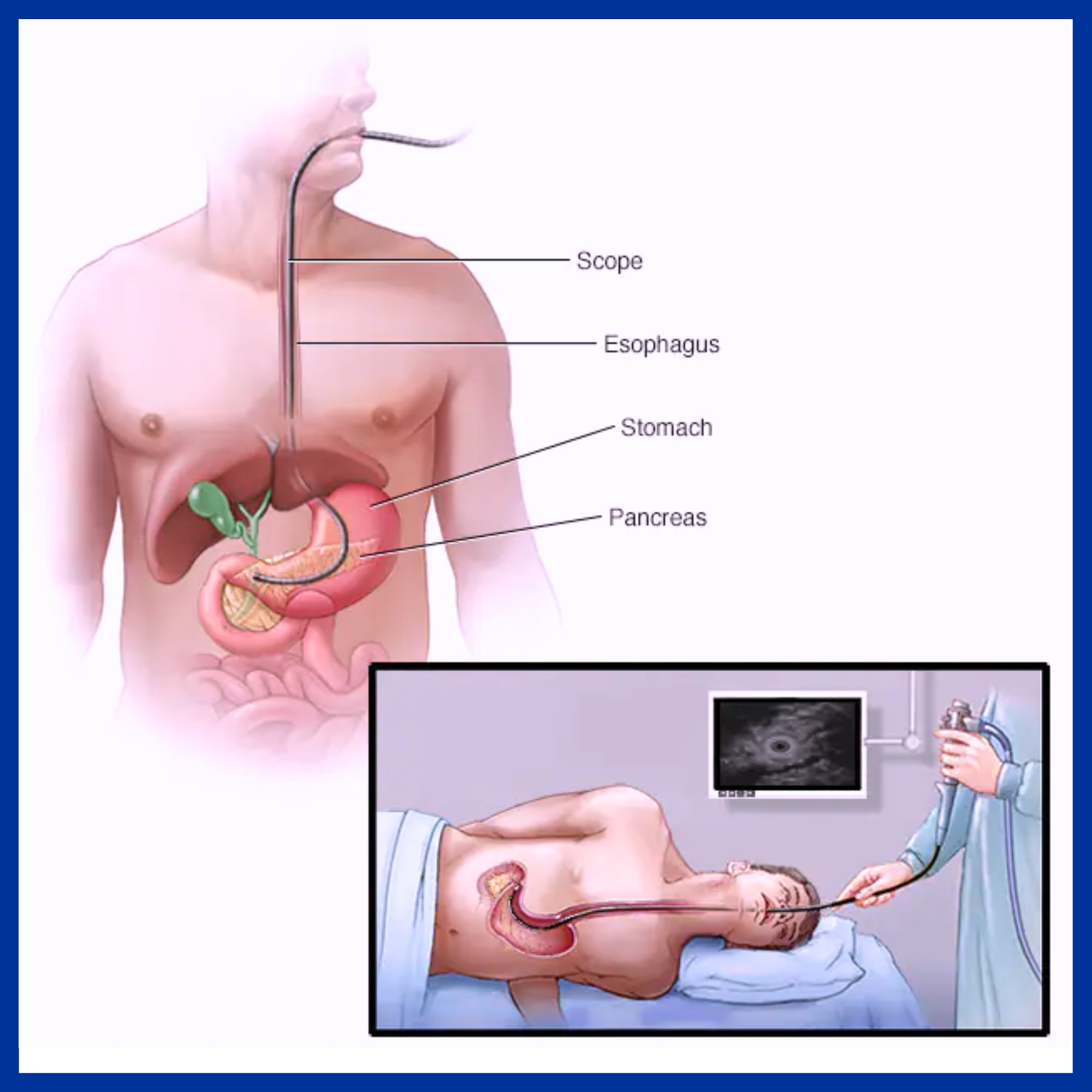 EUS (Endoscopic Ultrasound)