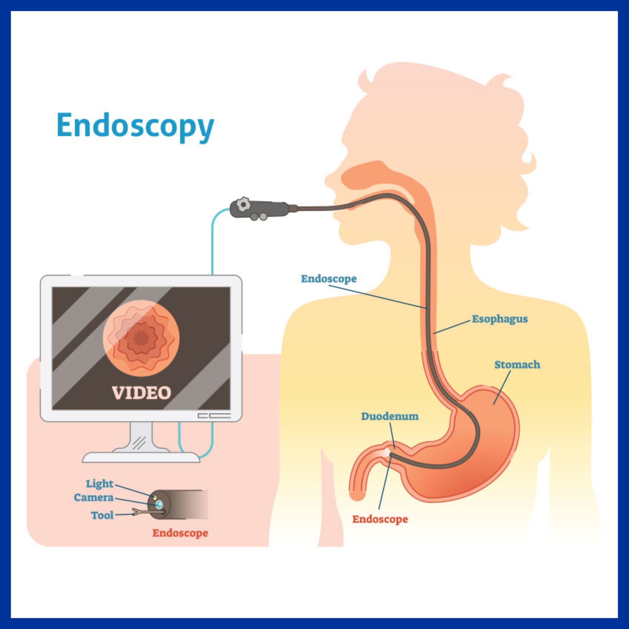 Endoscopy