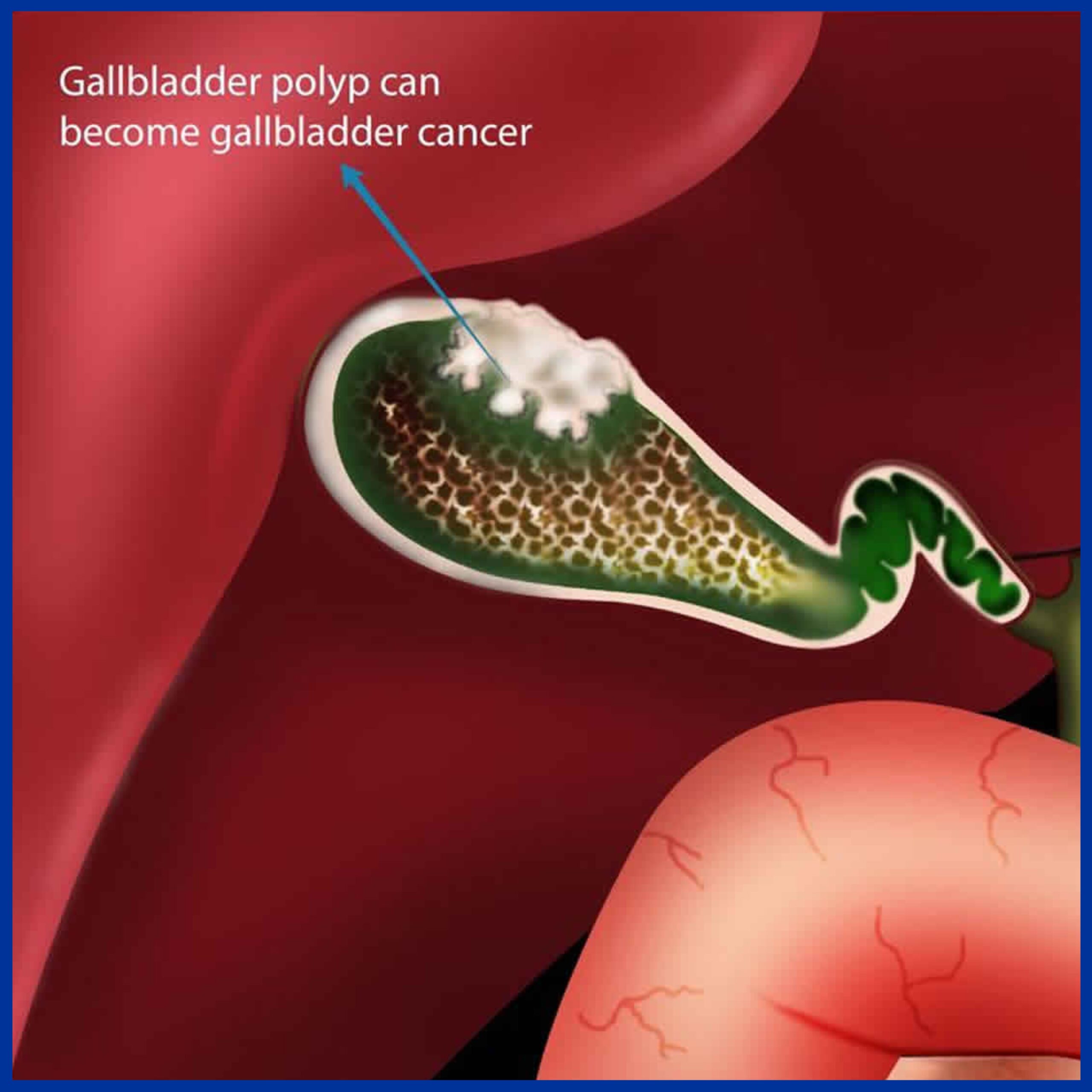 Cancer of Gallbladder