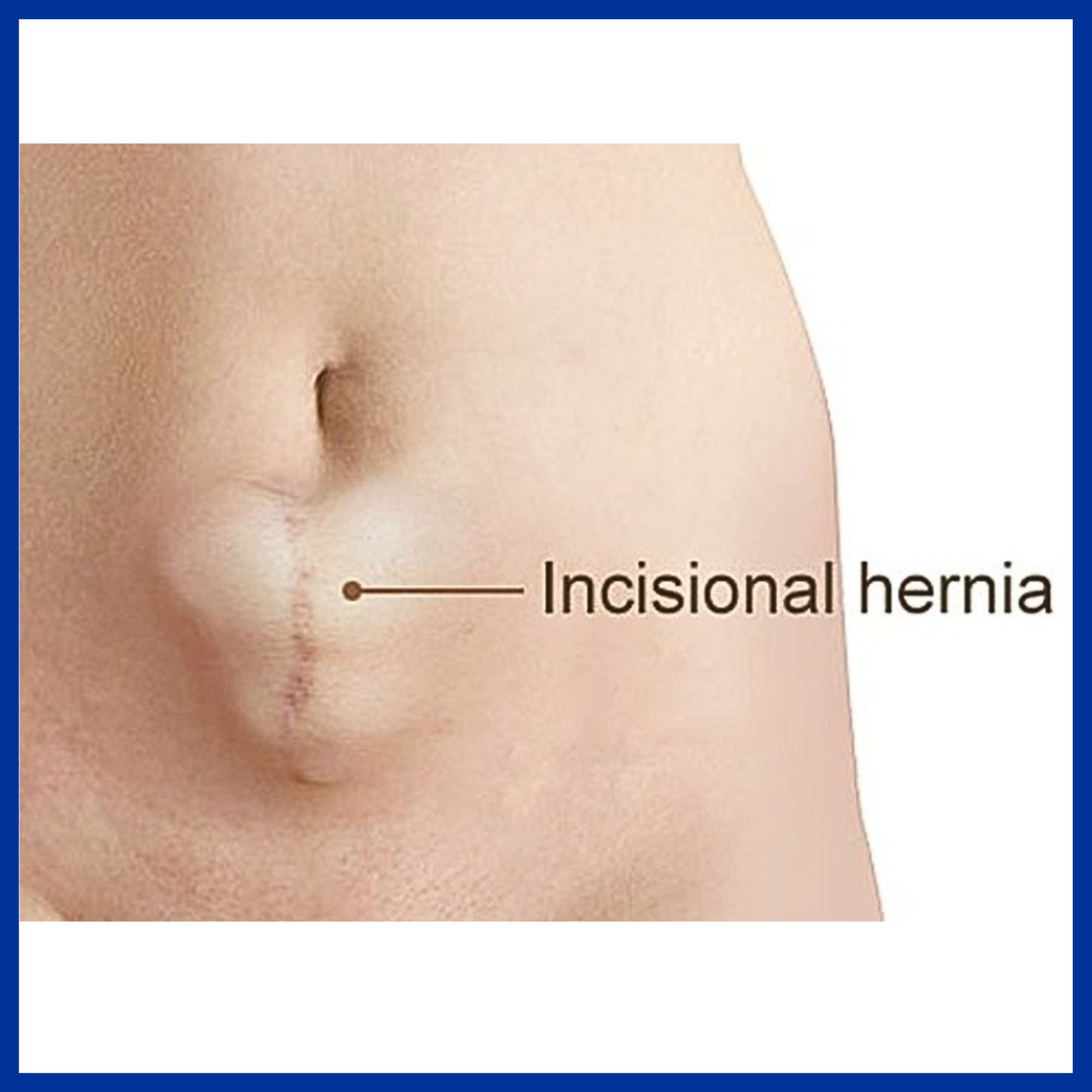 Incisional Hernia