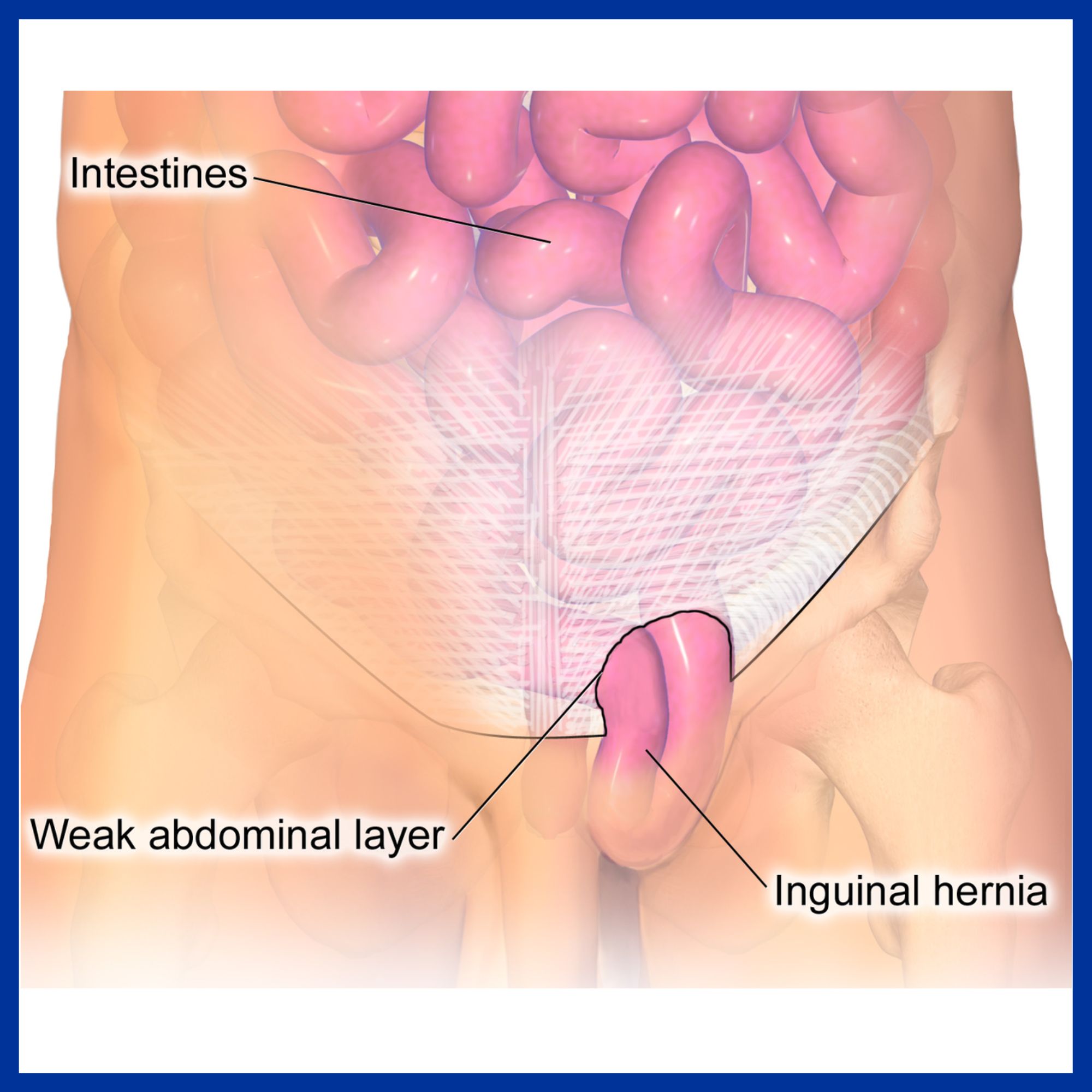 Inguinal Hernia