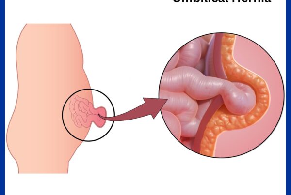 Umbilical Hernia