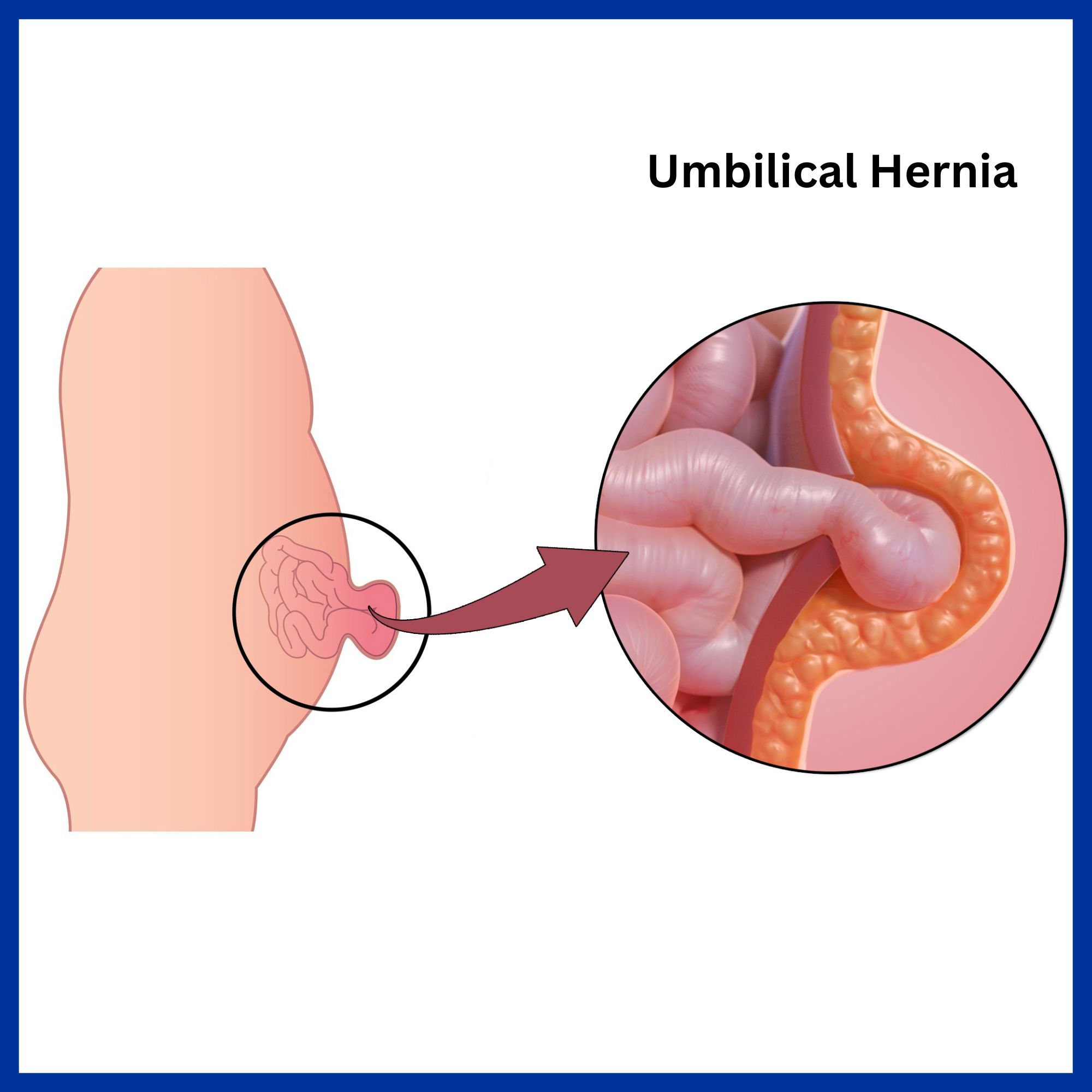 Umbilical Hernia