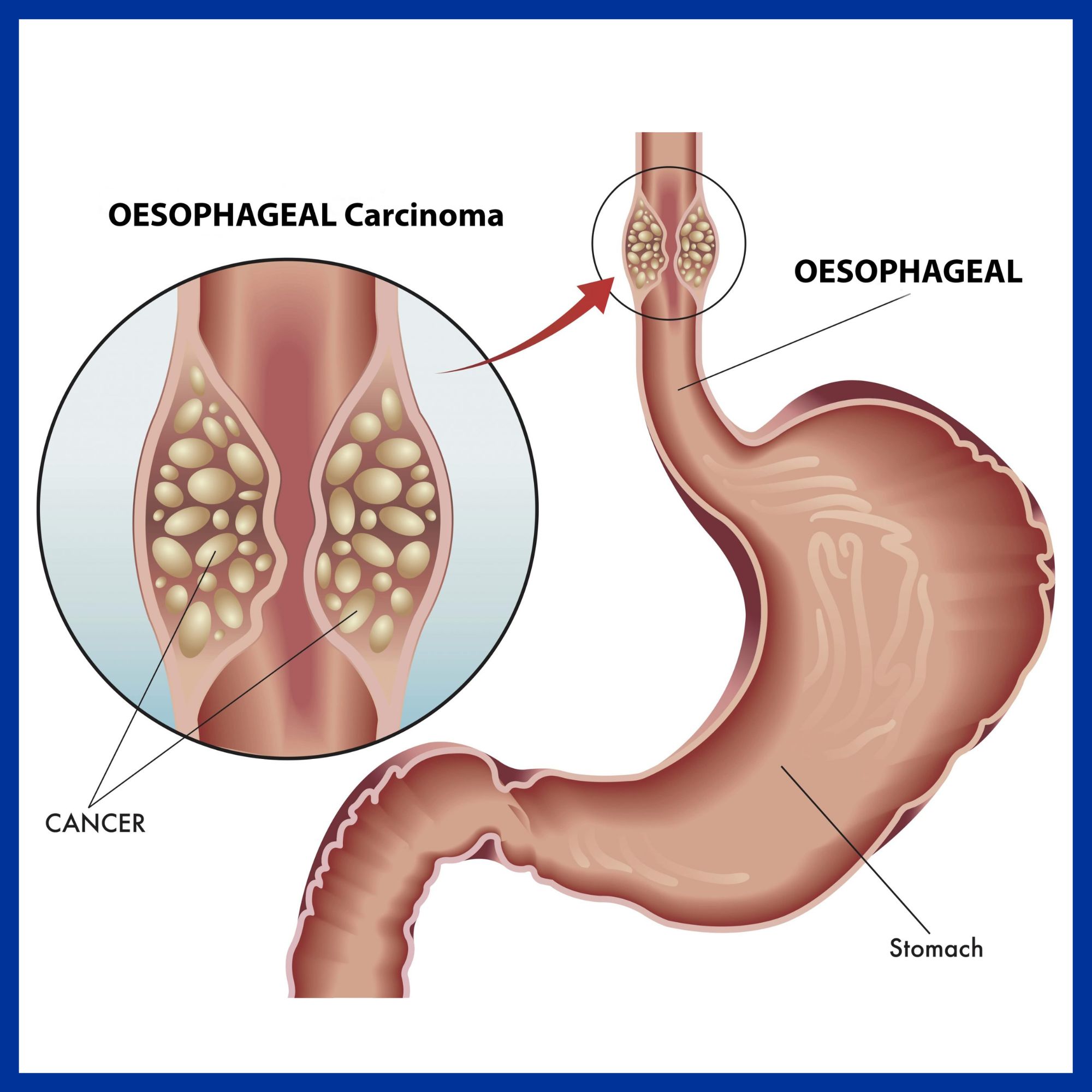 Cancer of Esophagus