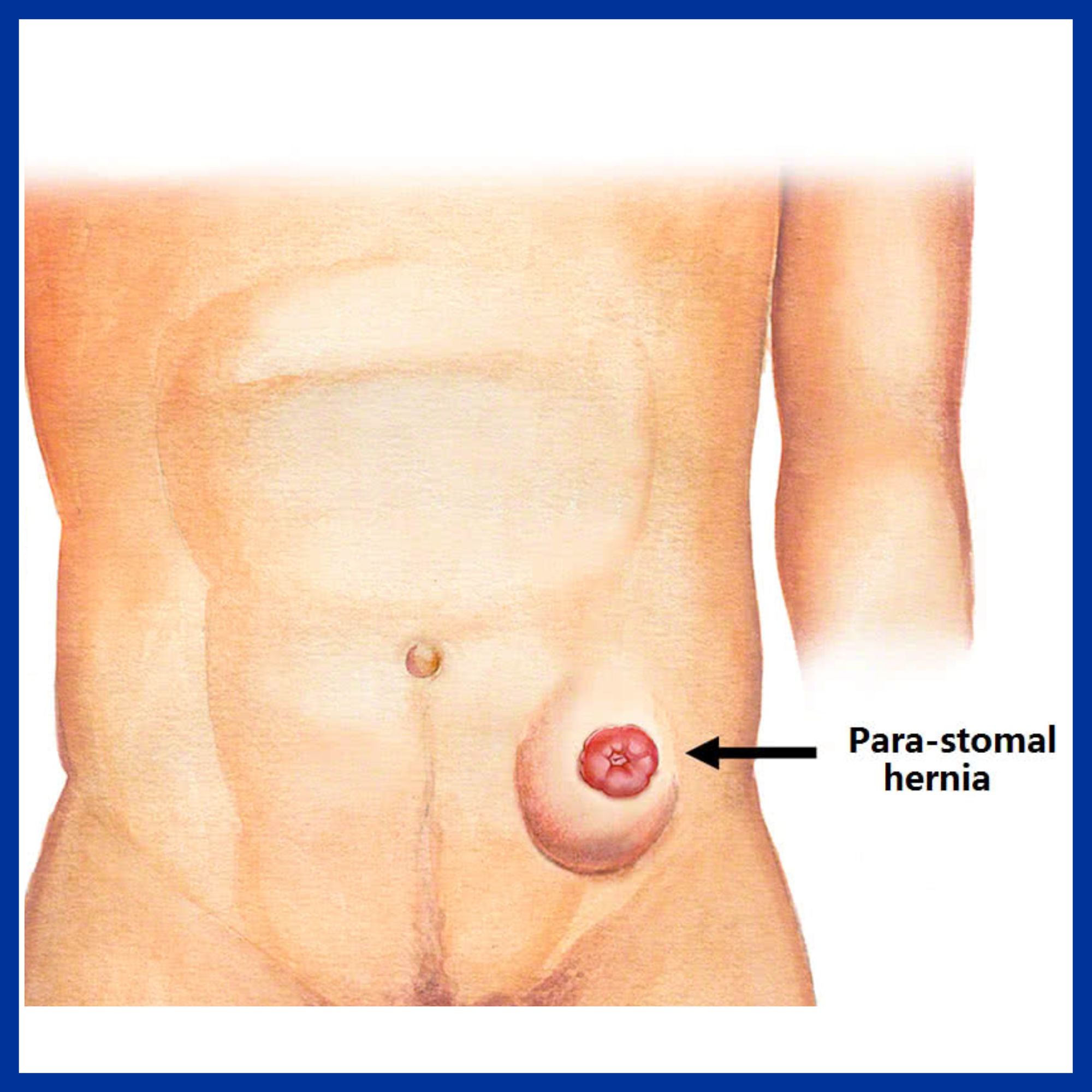 Parastomal Hernia