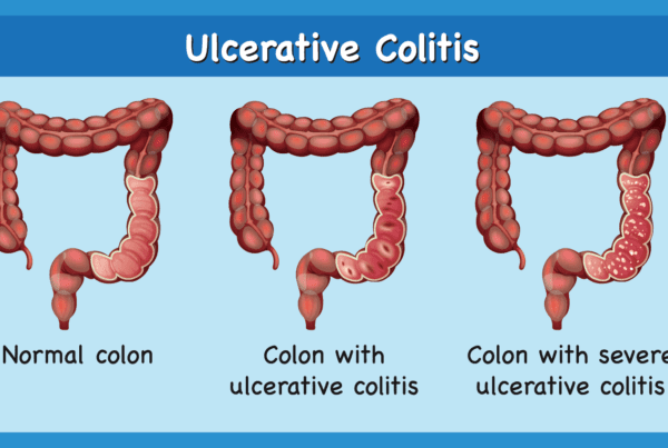 Ulcerative Colitis