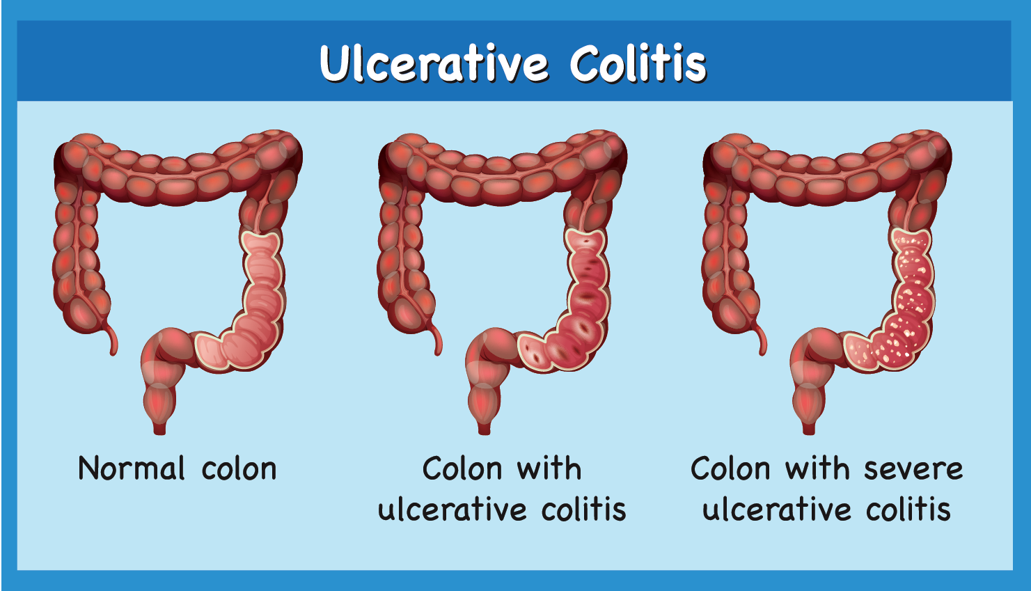 What Is Ulcerative Colitis?