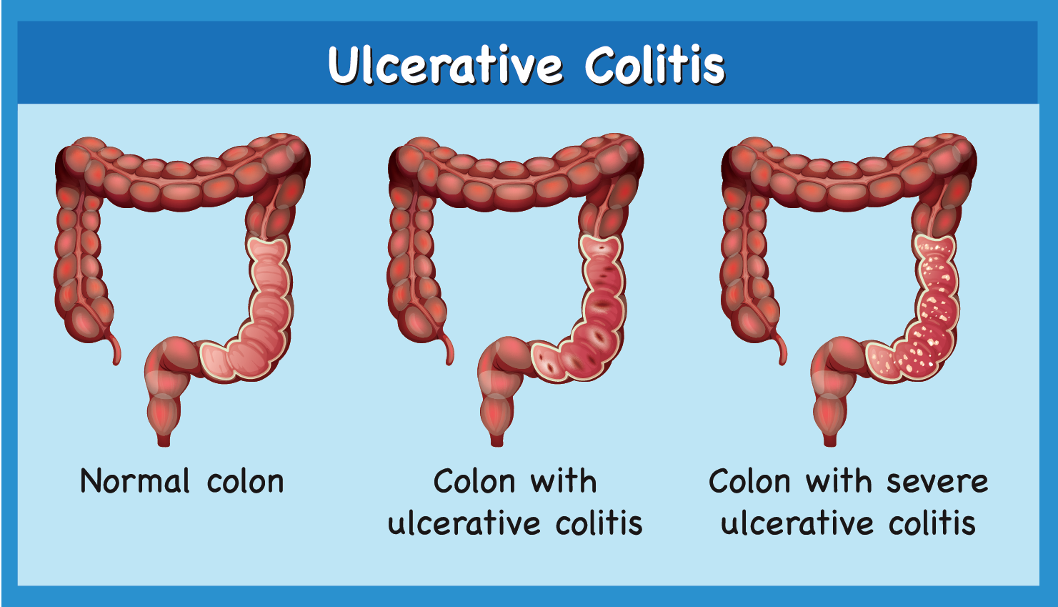 Ulcerative Colitis