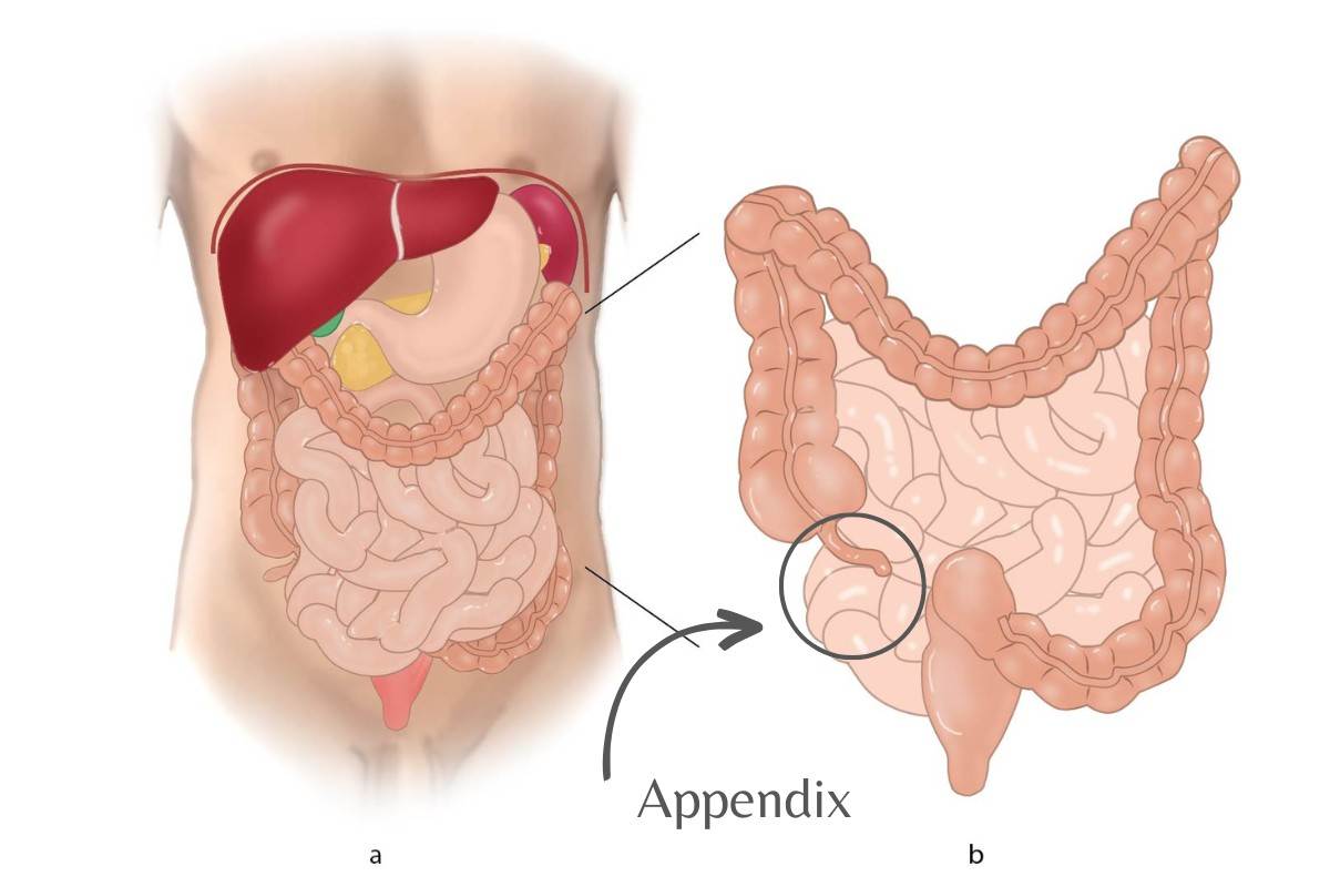 Appendix Diseases