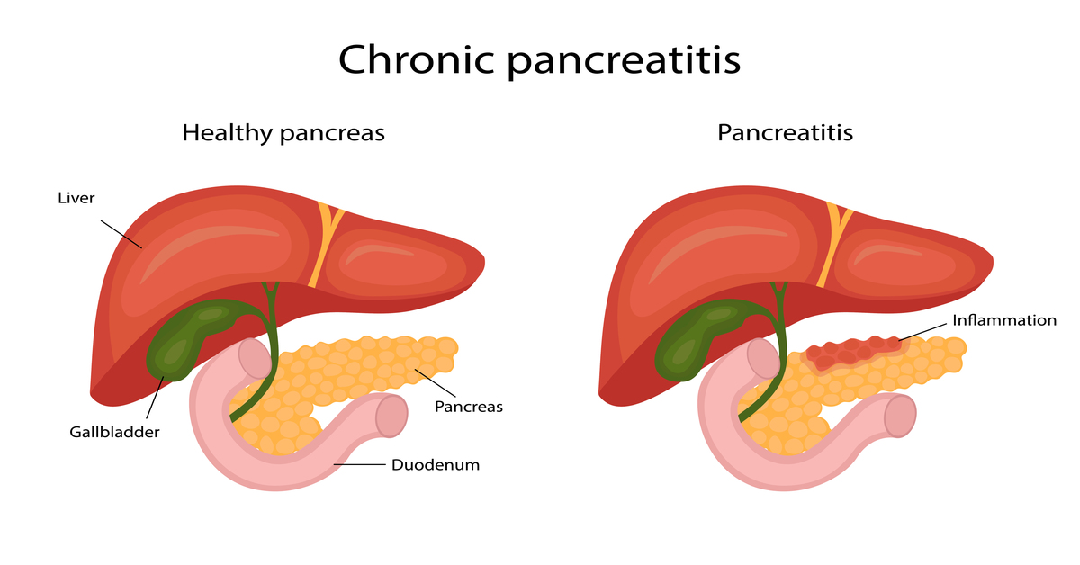 pancreatitis disease