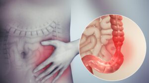 inflammatory bowel disease 