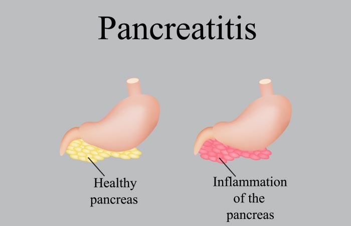 How to Prevent Pancreatitis?