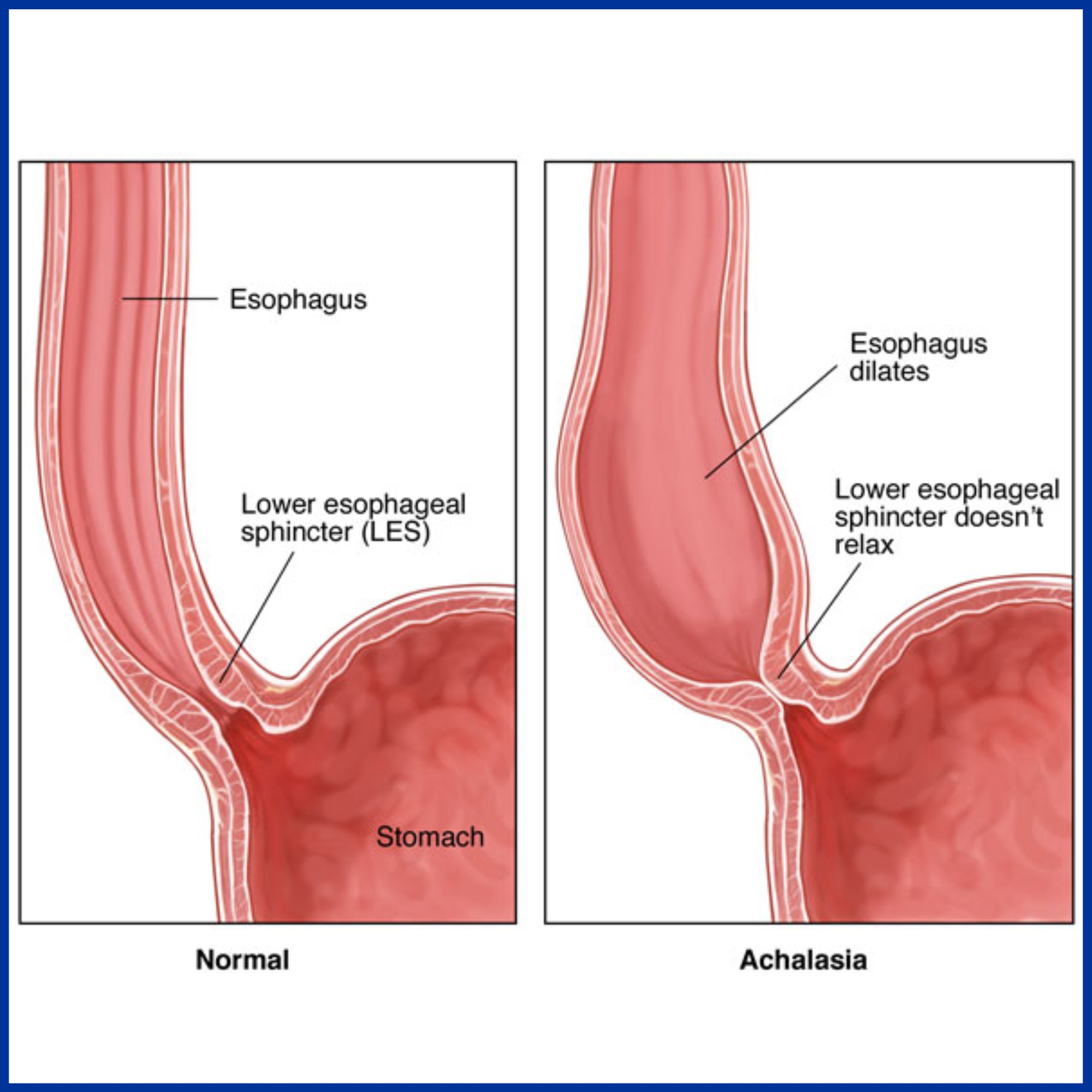 Achalasia Cardia