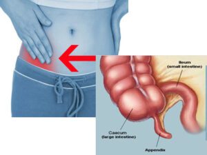 Appendicitis 