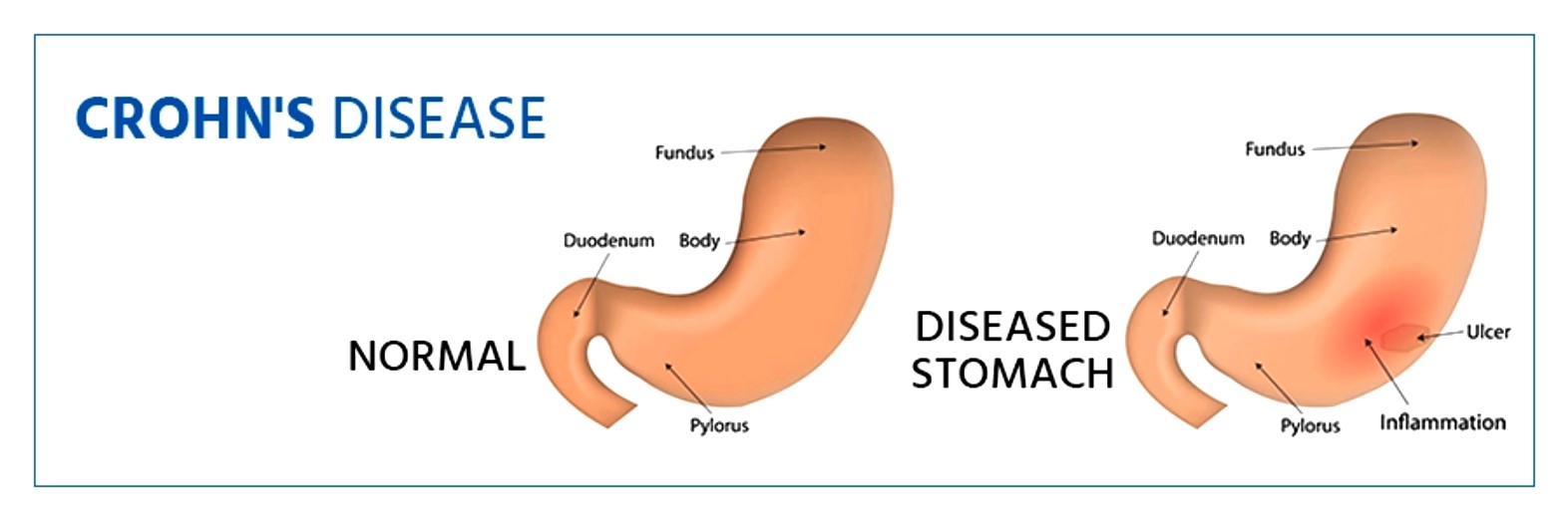 Crohn’s Disease