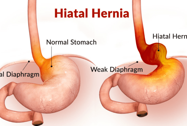 HIATUS HERNIA
