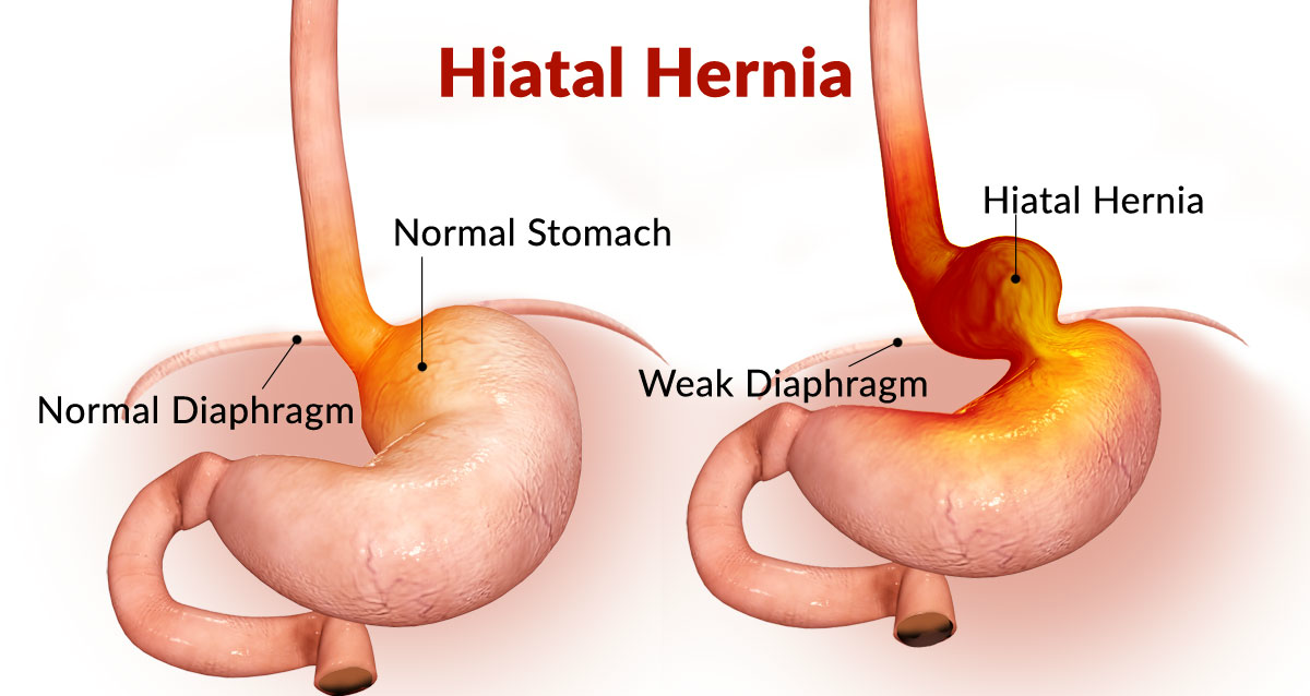 HIATUS HERNIA can be the cause of Recurrent Gas & Acidity