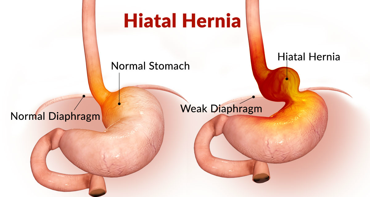 HIATUS HERNIA