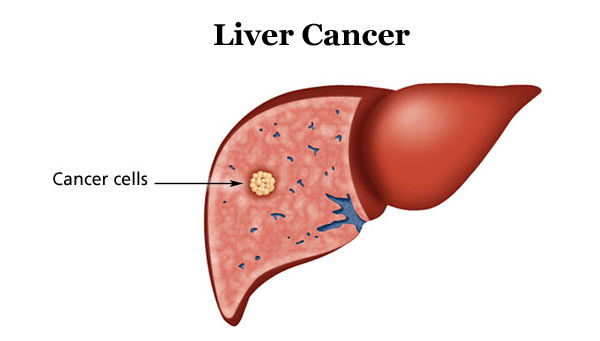 What is liver cancer?