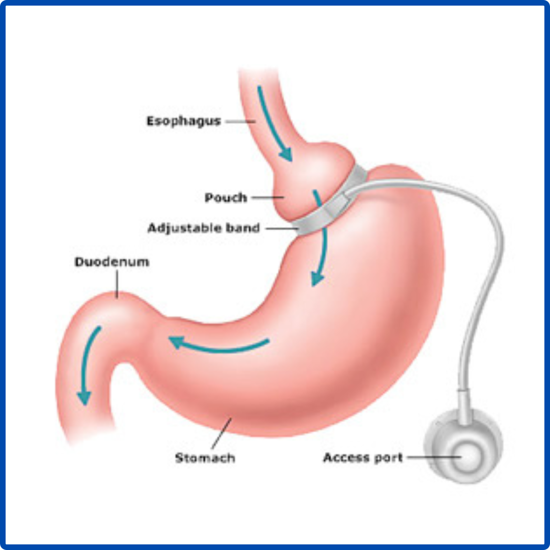 Robotic Obesity Surgery