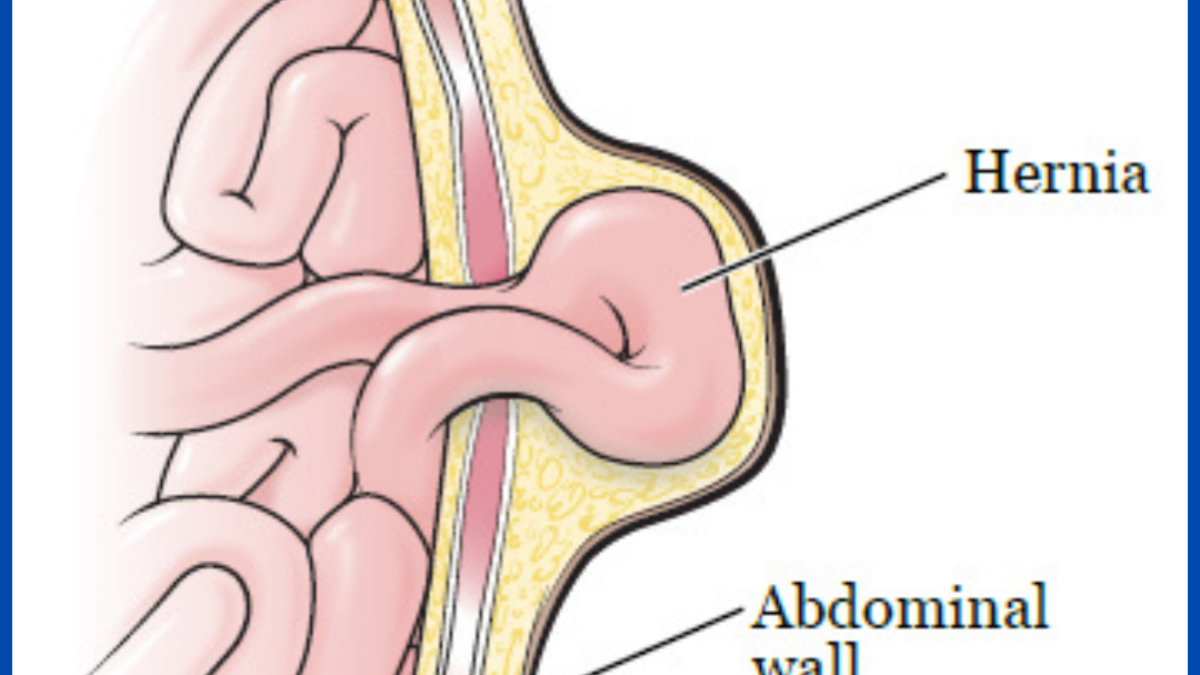 Hernia-Surgery-1200x675.png