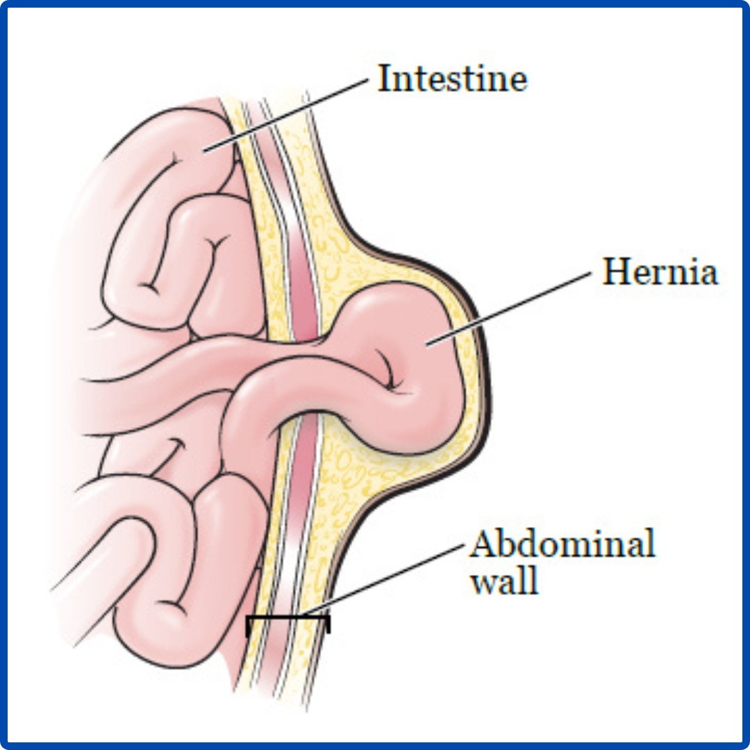 Robotic Hernia Surgery