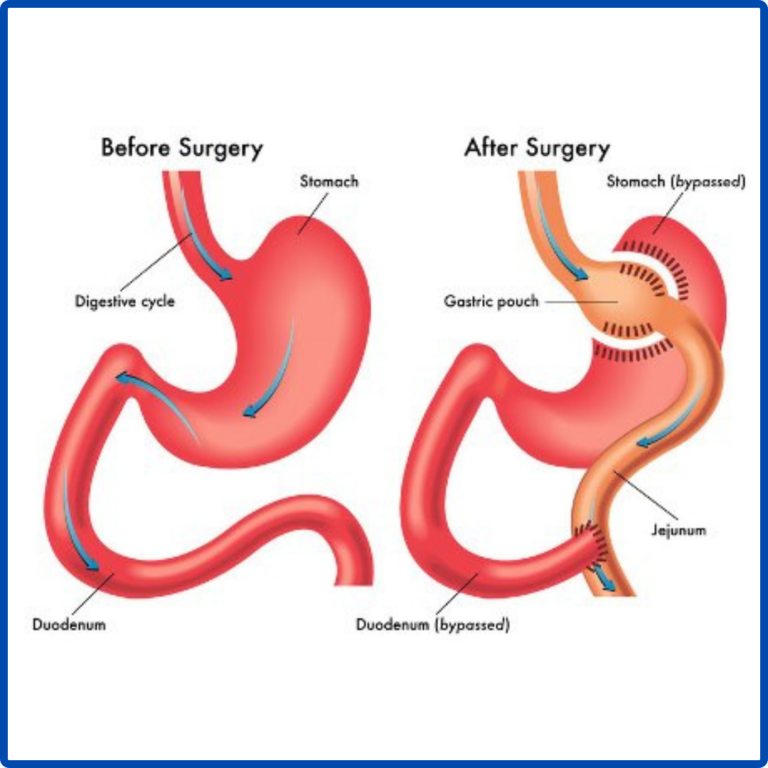 Robotic Gastric Bypass