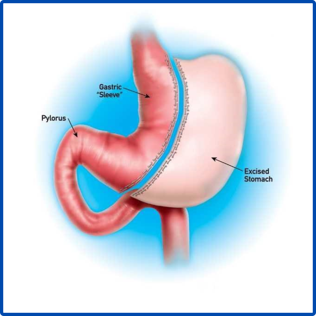 Robotic Obesity Surgery
