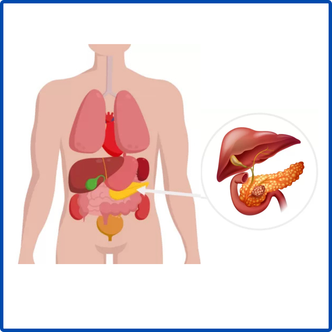 Robotic Pancreas Surgery | Kaizen Hospital