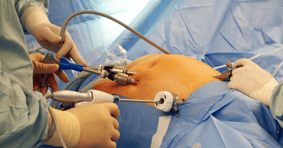 Bariatric Surgery: A Life-Changing Solution for Obesity