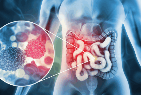 Colon Cancer and Its Symptoms