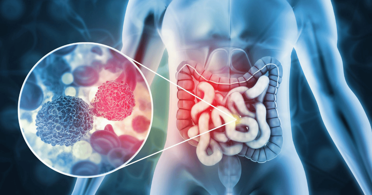 Colon Cancer and Its Symptoms