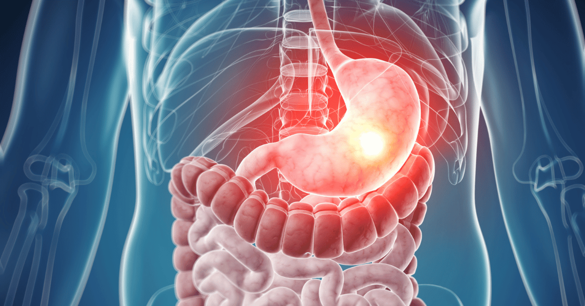 Gastroparesis: Symptoms, causes, diagnosis and treatment