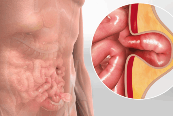 Hernia vs. Pulled Groin Muscle