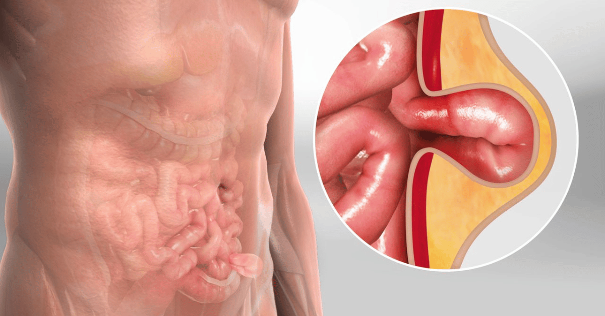 Hernia vs. Pulled Groin Muscle