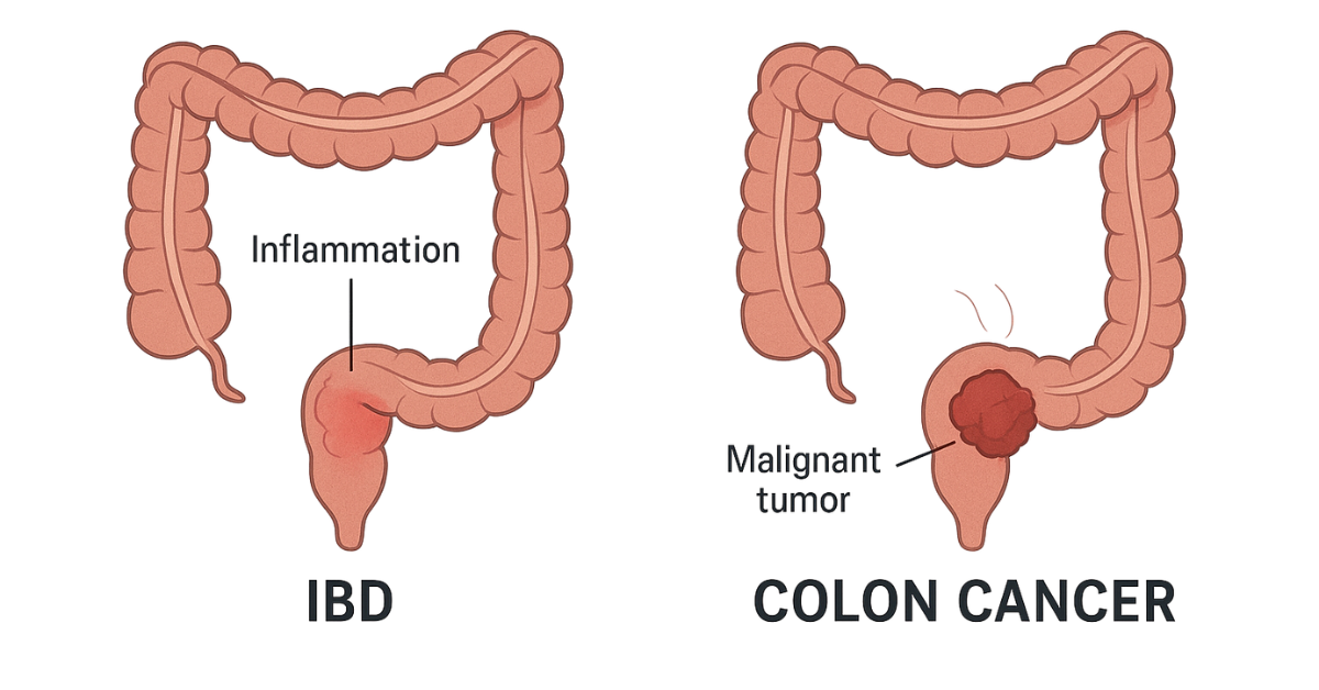 Colon Cancer Treatment in India