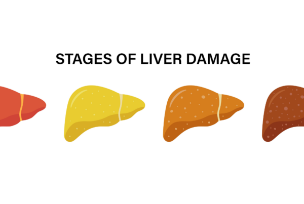 Different Stages of Liver Diseases