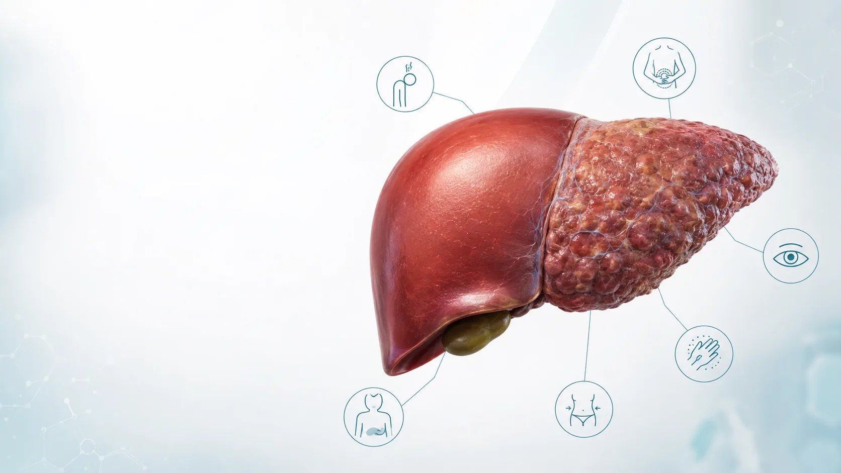 Liver Cirrhosis: Early Signs You Should Never Ignore