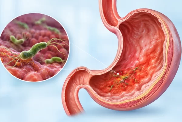 H. Pylori Infection: Symptoms, Test and Treatment